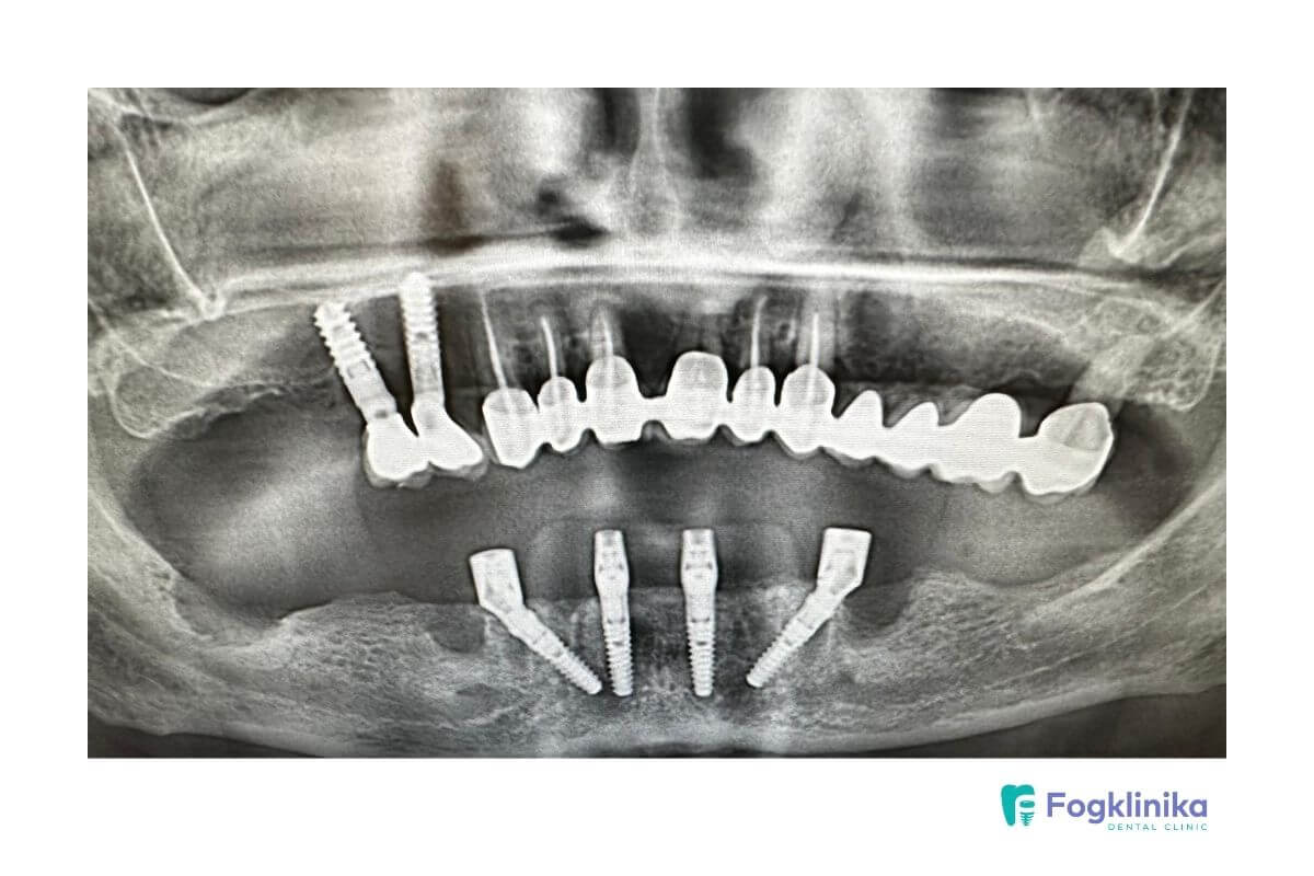 implant elotte